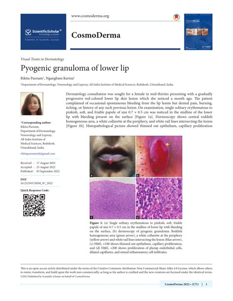 PDF Pyogenic Granuloma Of Lower Lip