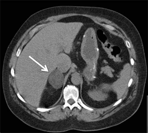 Abdominal Ct Scan Arrow Depicts Right Adrenal Mass Open I