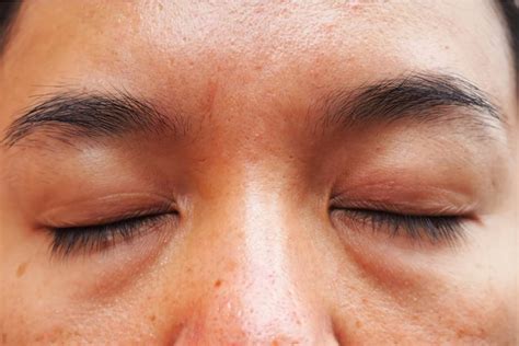 Common Types Of Eye Bags And How To Remove Them DAPS
