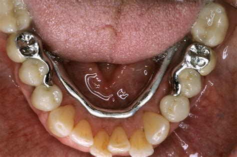 Partial Removable Dental Prosthesis Prdp Group Download Scientific