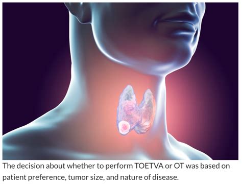 Transoral Endoscopic Thyroidectomy Vestibular Approach Safety And Outcomes