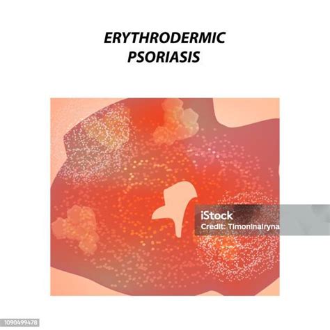 Ilustración De Psoriasis Eritrodérmica Eczema Dermatitis Psoriasis