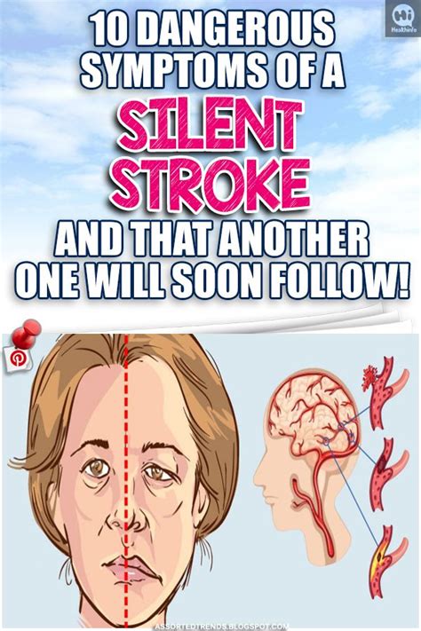 Dangerous Symptoms Of A Silent Stroke And That Another One Will Soon