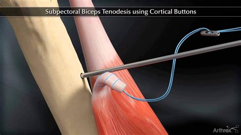 Subpectoral Biceps Tenodesis Using Cortical Buttons Youtube
