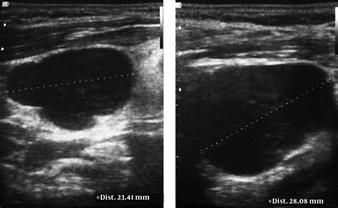Ultrasonography Of The Neck Lymph Nodes A 23 × 28 Millimeters Lymph