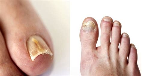 Why Are My Toenails Brittle And Flaky Design Talk