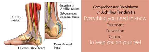 Achilles Tendonitis The Complete Guide To Causes And Treatments