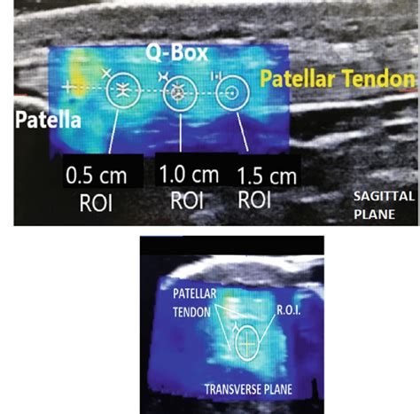 Jan 23, 2018 · a dislocated kneecap is yet another common knee condition. Ultrasound elastography of patellar tendon for both ...