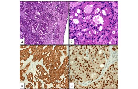 A Overview Of Sinonasal Salivary Type Ductal Adenocarcinoma Showed Download Scientific