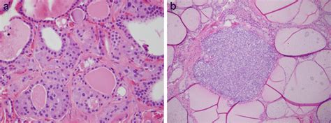 C Cell Hyperplasia With Intrafollicular Proliferation Of C Cells