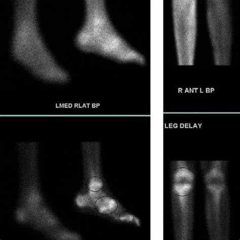 -Bilateral lower extremity 99Tc bone scan demonstrates increased tracer Картинка - -Bilateral lower extremity 99Tc bone scan demonstrates increased tracer