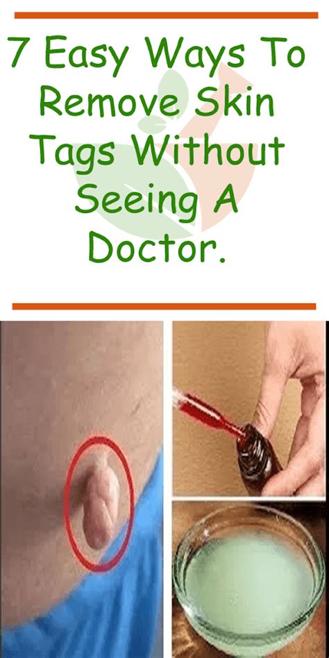 7 easy ways to remove skin tags without visiting a doctor healthy lifestyle