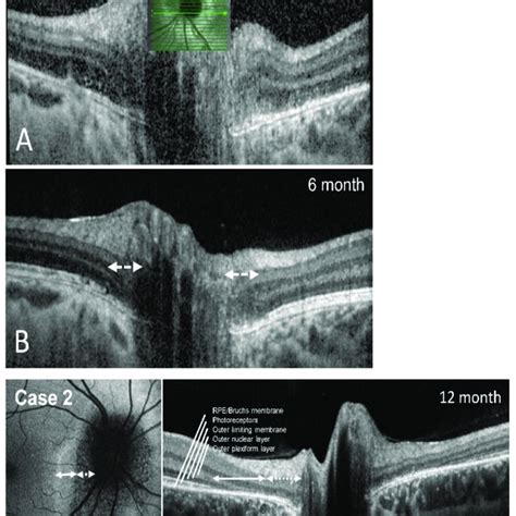 Restoration Of Outer Retinal Layer Anatomy Sd Oct Scans Heidelberg