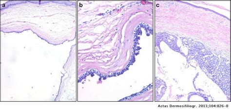 Dermatoscopy Of Apocrine Tumors Report Of 4 Cases Actas Dermo