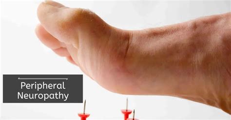 Peripheral Neuropathy Types Symptoms Causes Risk Factors