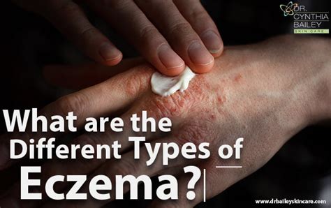 Discover The Different Types Of Eczema From Dr Bailey