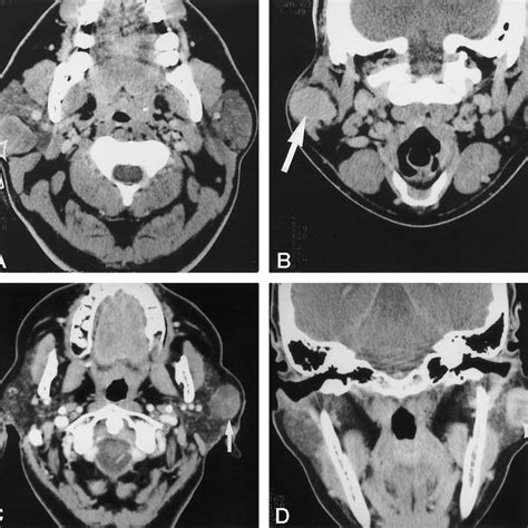 A Axial Ct Scan Of A Typical Parotid Pleomorphic Adenoma Obtained 7