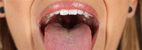 Leukoplakia Of The Oral Cavity A Pathology Dangerous To Health