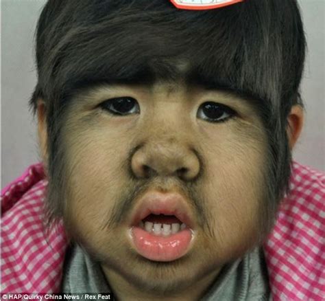 Chinese Girl Jing Jing With Rare Genetic Werewolf Syndrome To