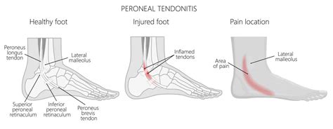 Peroneal Tendonitis Strains And Tears Treatment Bioskin Bracing