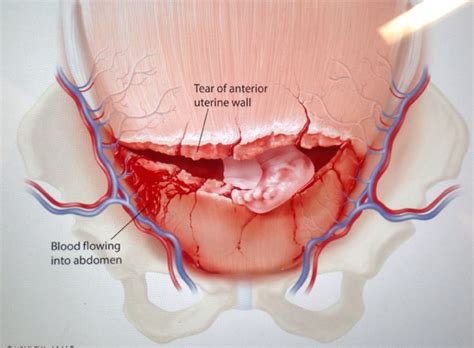uterine rupture stepwards