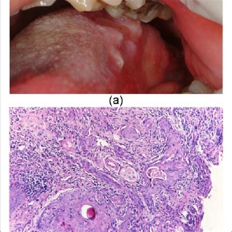 Pdf Two Unusual Cases Of Oral Lichen Planus Arising After Oral