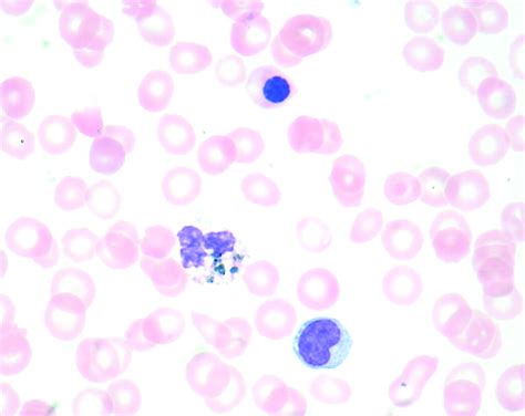 Green Neutrophilic Inclusions In Liver Disease Journal Of Clinical
