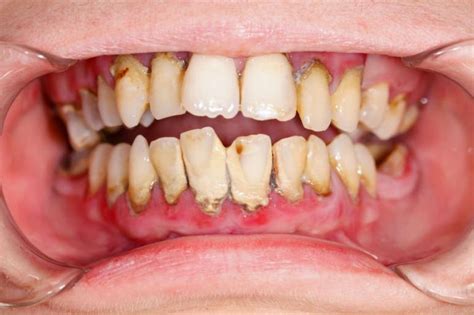 How Sugar Will Destroy Your Teeth Do This To Prevent Damage This