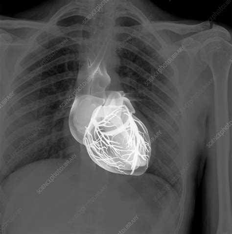 Heart And Lungs Chest X Ray Composite Stock Image C0115758