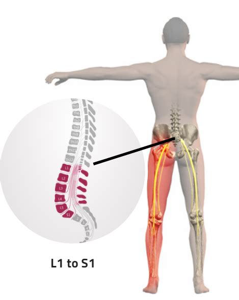 A slipped disk may cause symptoms such as pain down the back of the leg (sciatica), numbness, or weakness. 31