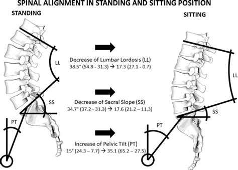 The Sitting Vs Standing Spine North American Spine Society Journal