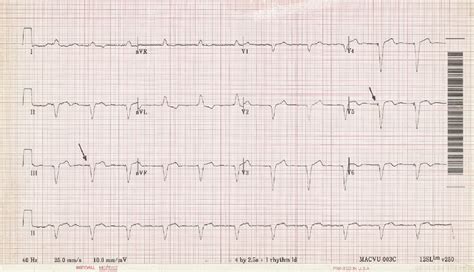 12 Lead Ecg Demonstrating Ventricular Paced Rhythm Note The
