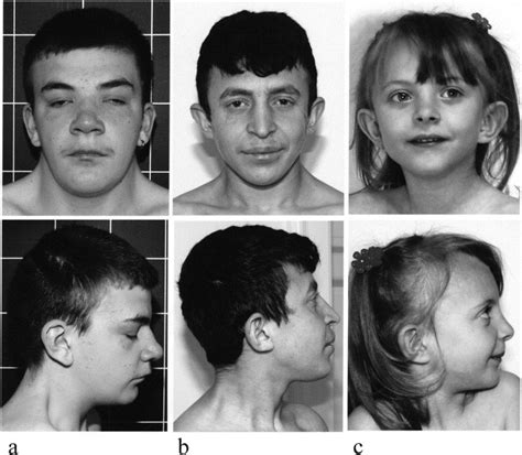 Genotype Phenotype Correlations In Noonan Syndrome The Journal Of