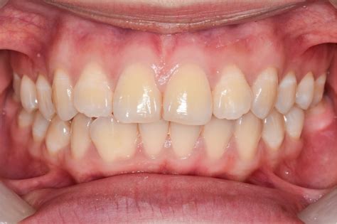 What Are The Symptoms Of Oral Cancer On The Gums