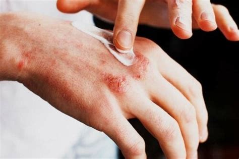 Types Of Skin Rash And Their Causes Step To Health