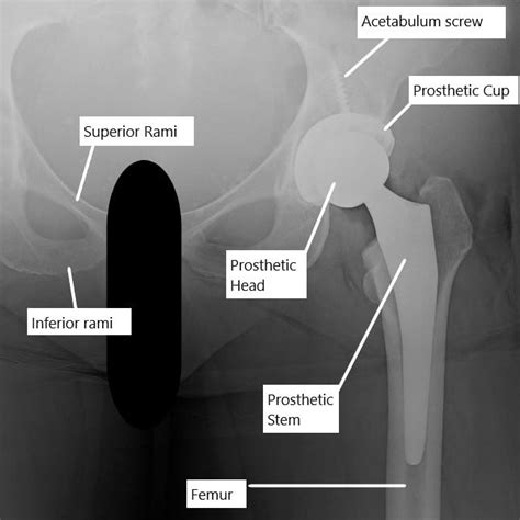 Pain After Hip Replacement Complete Orthopedics Multiple Ny Locations