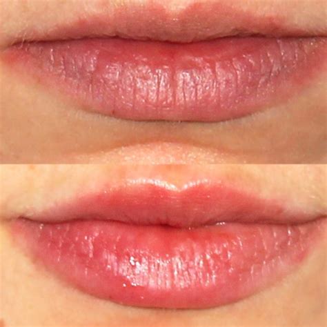 White Spots On Lips After Injections Lipstutorial Org