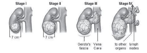 Stages Of Tumor Growth In Kidney Download Scientific Diagram
