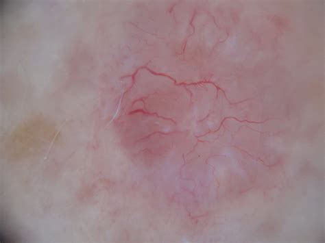 The main types of skin cancer are squamous cell carcinoma, basal cell carcinoma, and most deaths from skin cancer are caused by melanoma. Non-Melanoma Skin Cancer (NMSC) - South East Dermatology