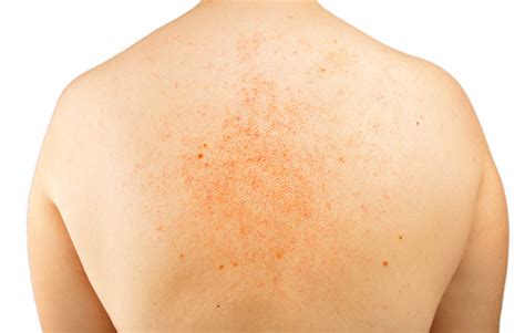 Eczema On My Back Stock Photo Download Image Now Istock