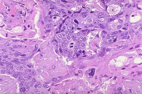Squamous Cell Carcinoma Poorly Differentiated Pathology Student