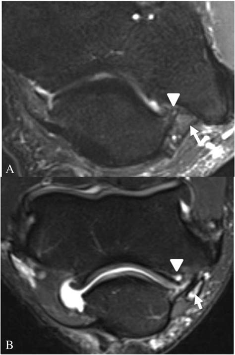 Mr Anatomy And Pathology Of The Ulnar Nerve Involving The Cubital