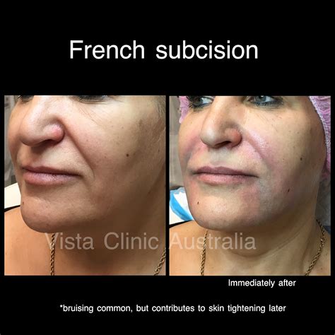 Subcision Of Wrinkles Before And After Vista Clinic Melbourne Australia