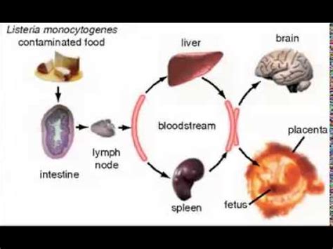 Learn and reinforce your understanding of listeria monocytogenes through video. Listeria monocytogenes, gram-positive rod, one cause of ...