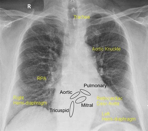 Cardiac Valves Chest X Ray