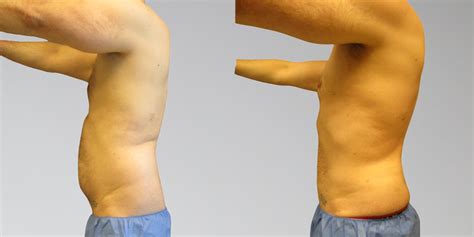 Men Before And After Stomach Liposuction Sono Bello