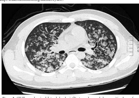 Diffuse Alveolar Hemorrhage Diffuse Alveolar Hemorrhage Semantic Scholar