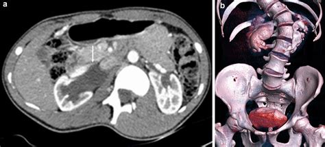 Horseshoe Kidney With Right Puj Obstruction And Scoliosis In A