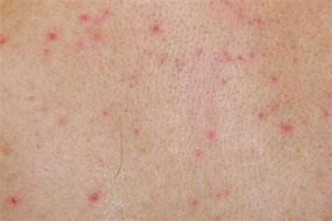 Rashes Caused By Viruses Pictures Photos