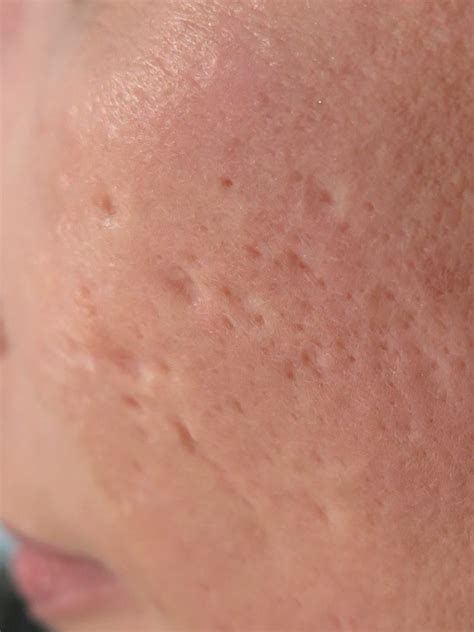 Advances In Understanding Atrophic Acne Scarring And The Role Of
